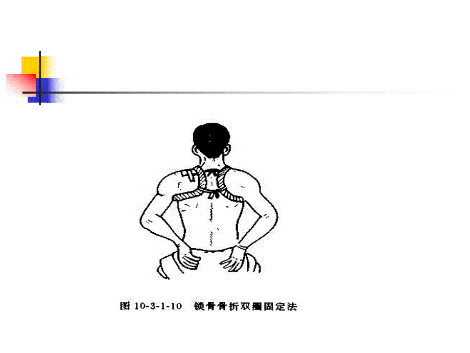 骨折急救固定法[精彩].ppt_第3页