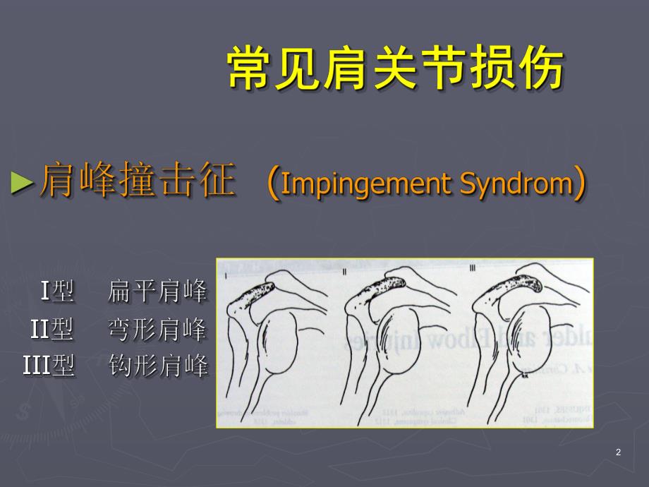 肩关节镜手术期护理要点.ppt_第2页