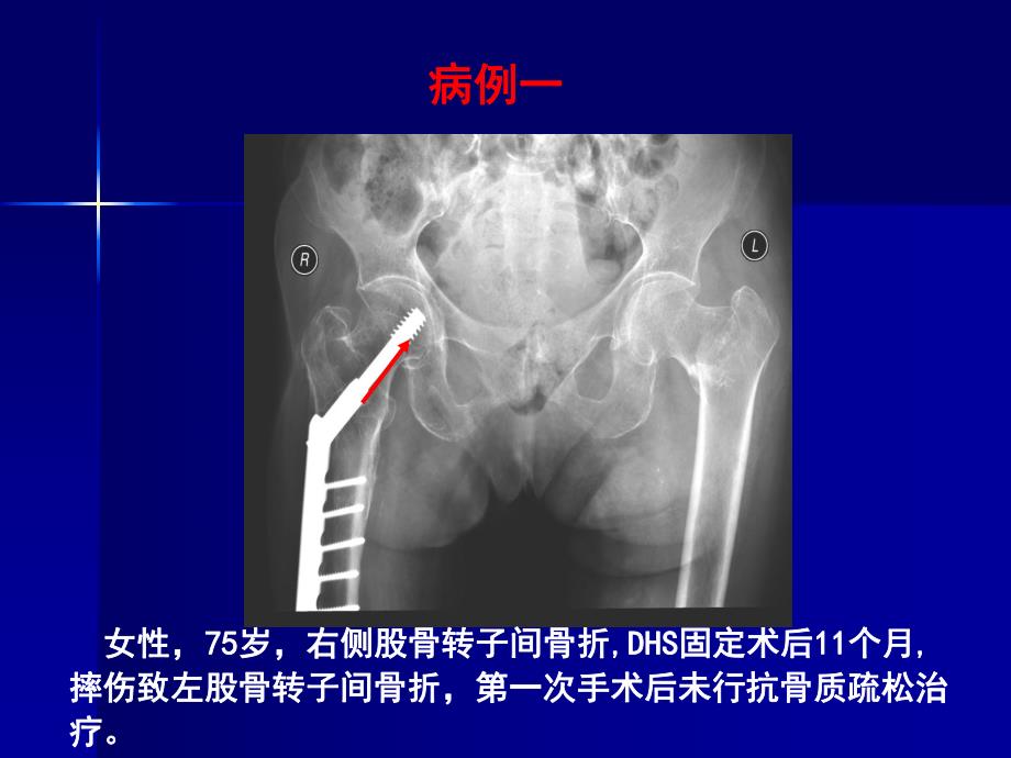 骨质疏松症诊断与防治.ppt.ppt_第3页