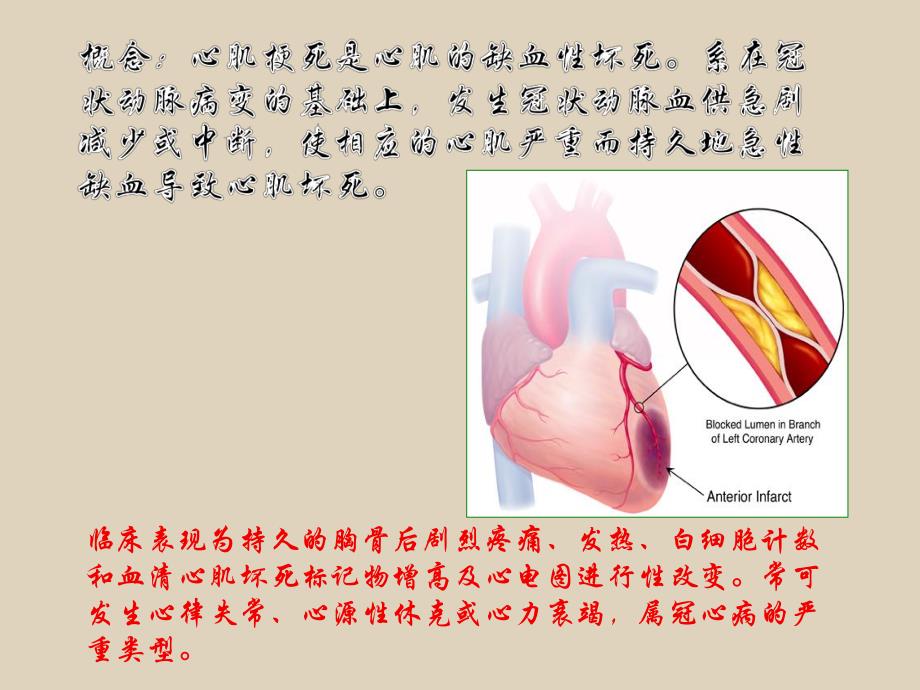 心肌梗死的护理常规.ppt.ppt_第2页