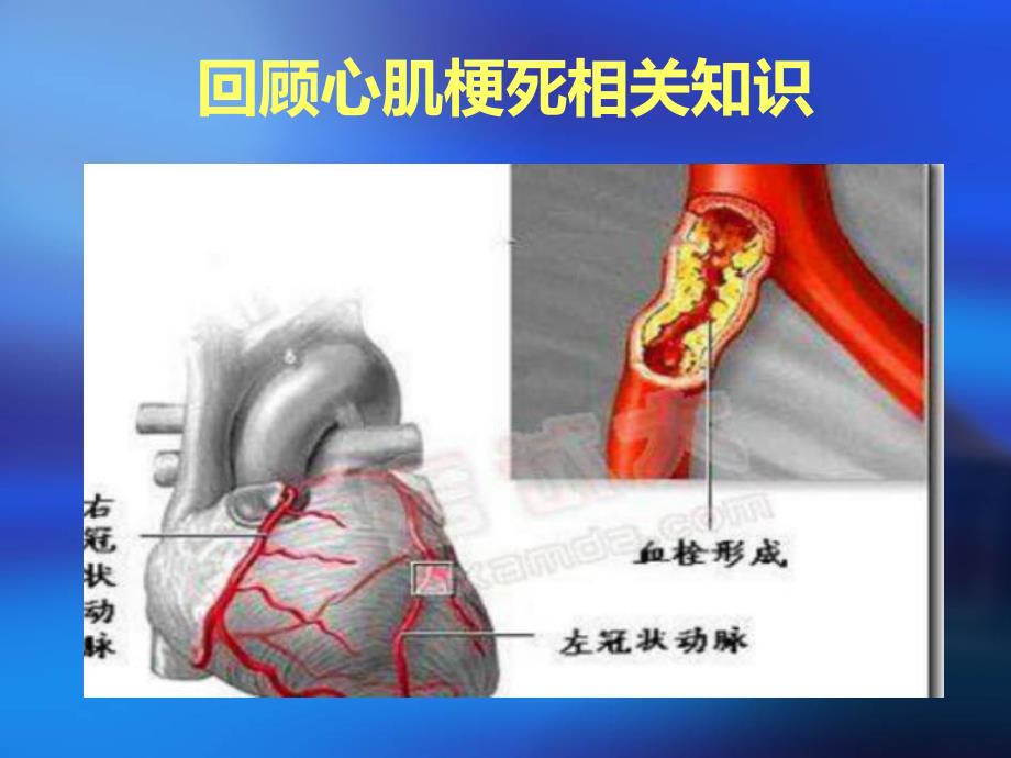 心肌梗塞护理查房.ppt_第2页