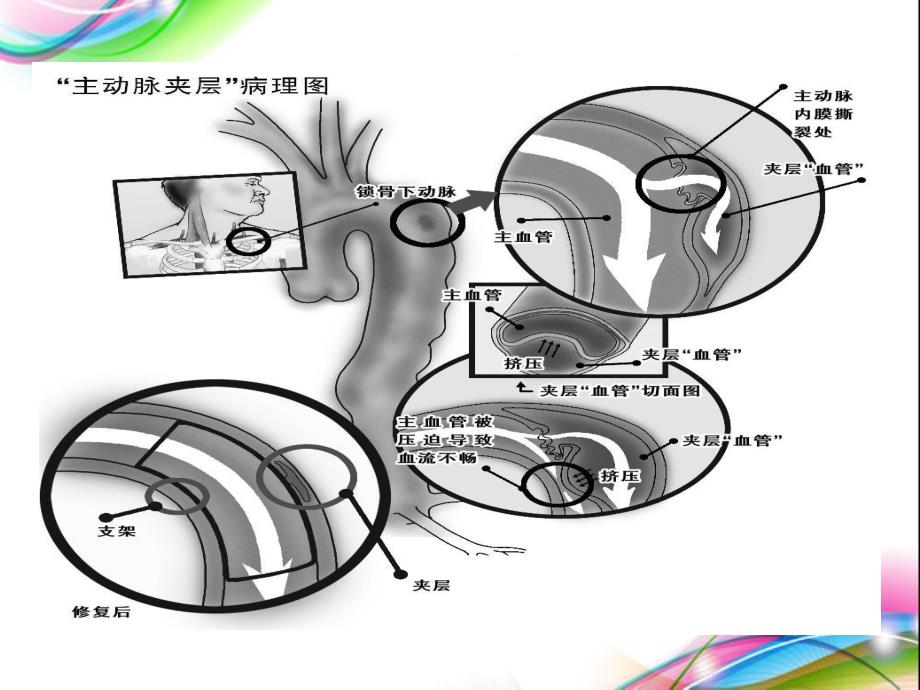 主动脉夹层护理查房.ppt_第3页