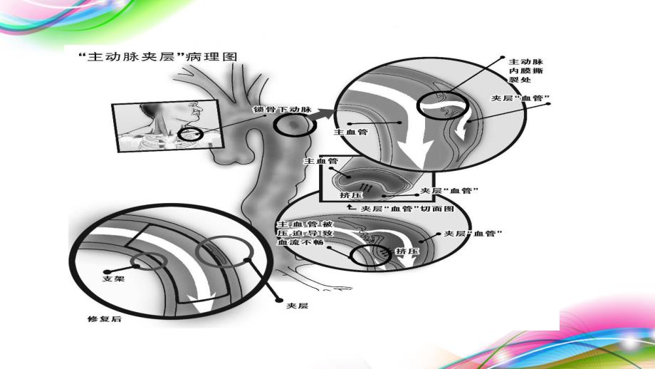 主动脉夹层护理查房.ppt_第3页