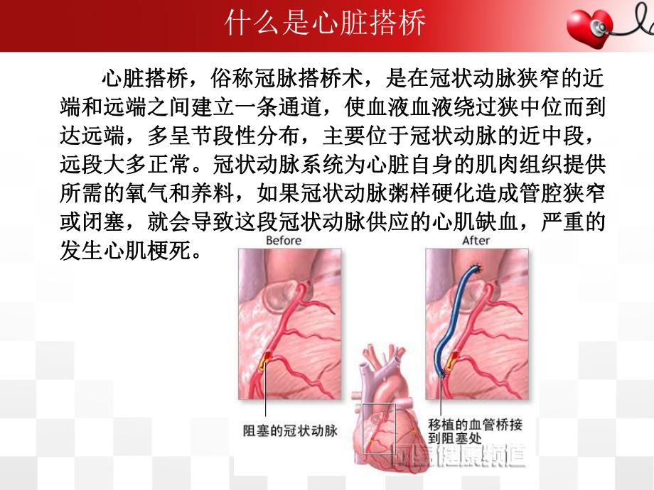 冠脉搭桥术后护理查房.ppt_第2页