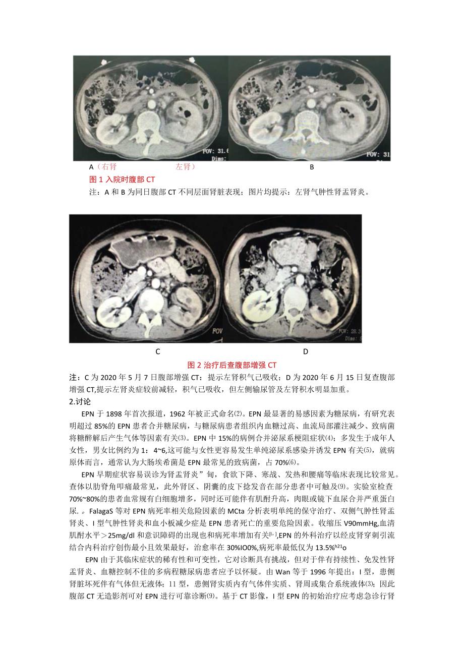 系统性红斑狼疮合并气肿性肾盂肾炎一例并文献复习.docx_第2页