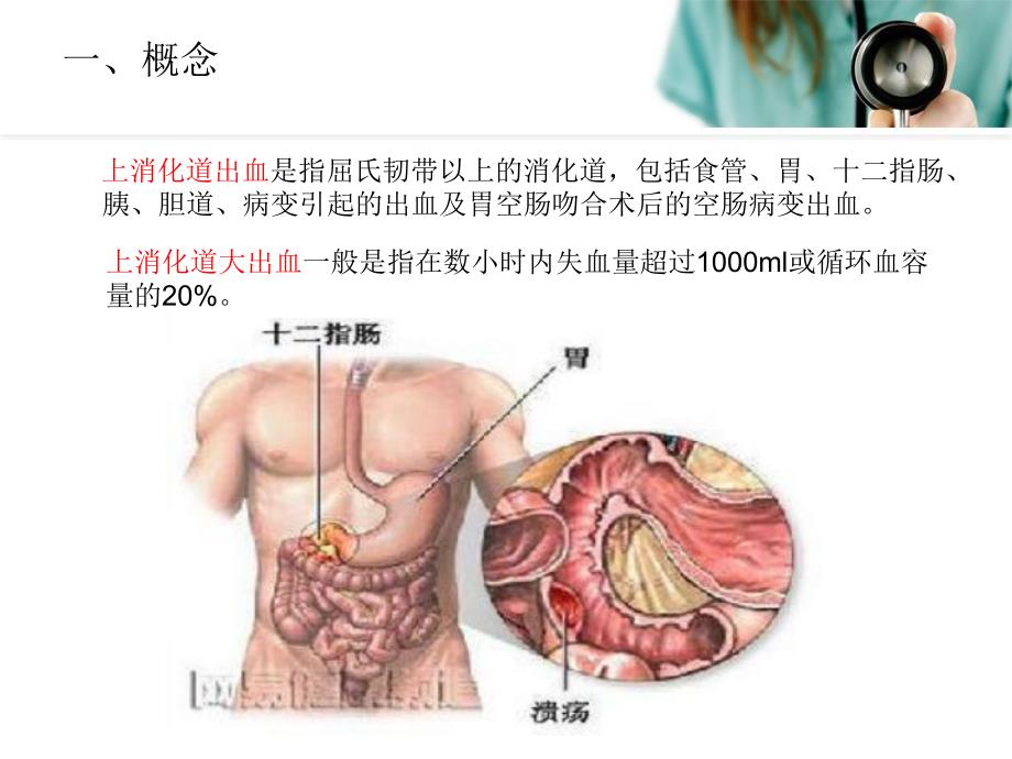 上消化道大出血患者的护理.ppt_第3页