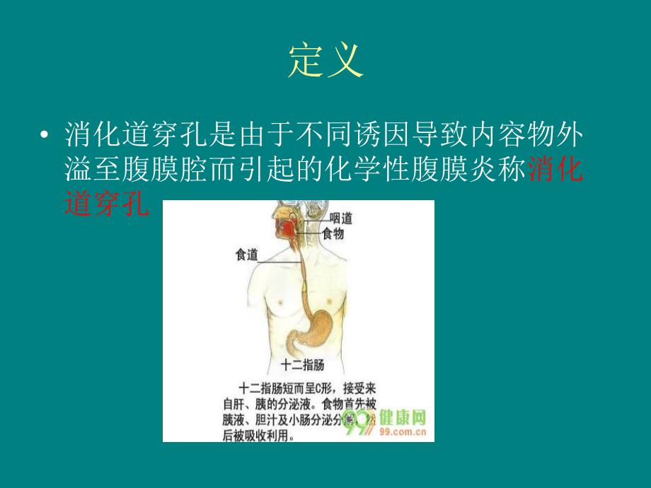 上消化道穿孔的护理.ppt_第2页