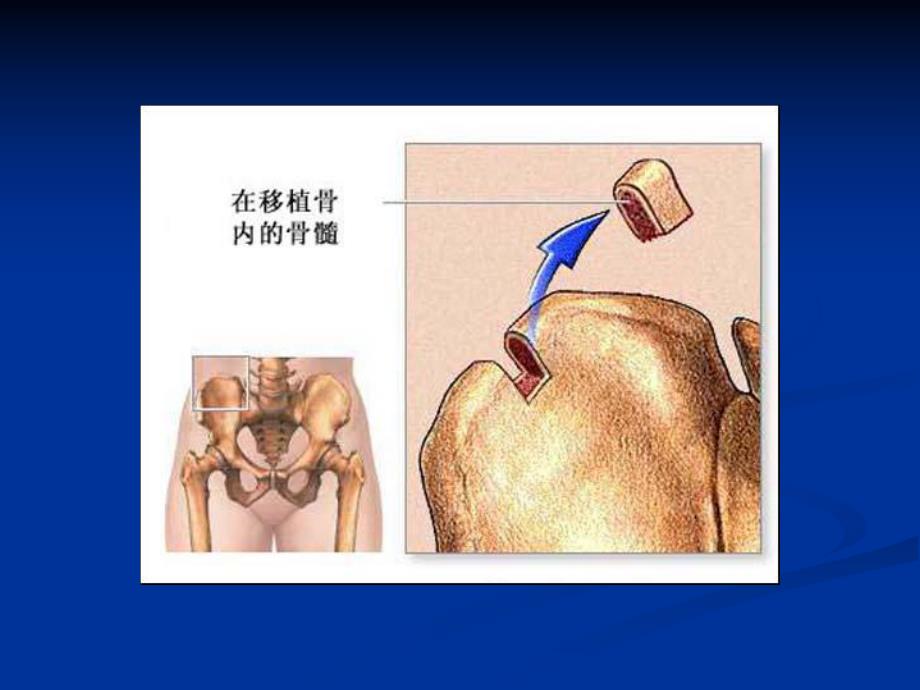 骨髓移植患者的护理.ppt_第3页