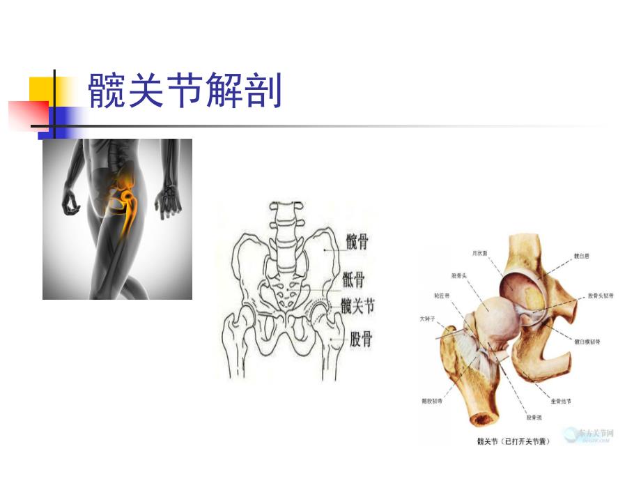 髋关节置换护理查房.ppt_第3页