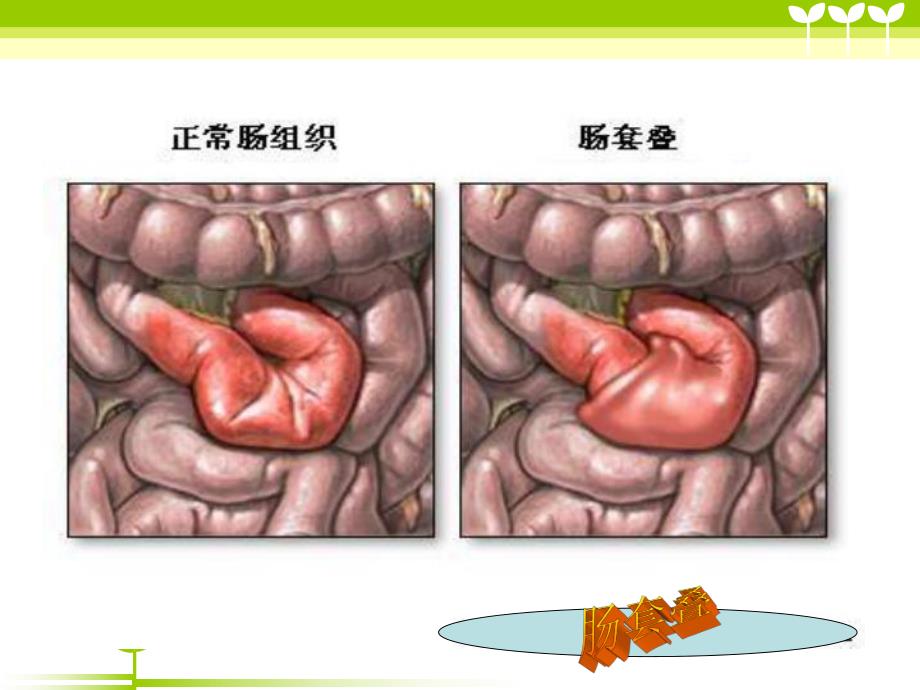 肠套叠患儿的护理.ppt_第3页