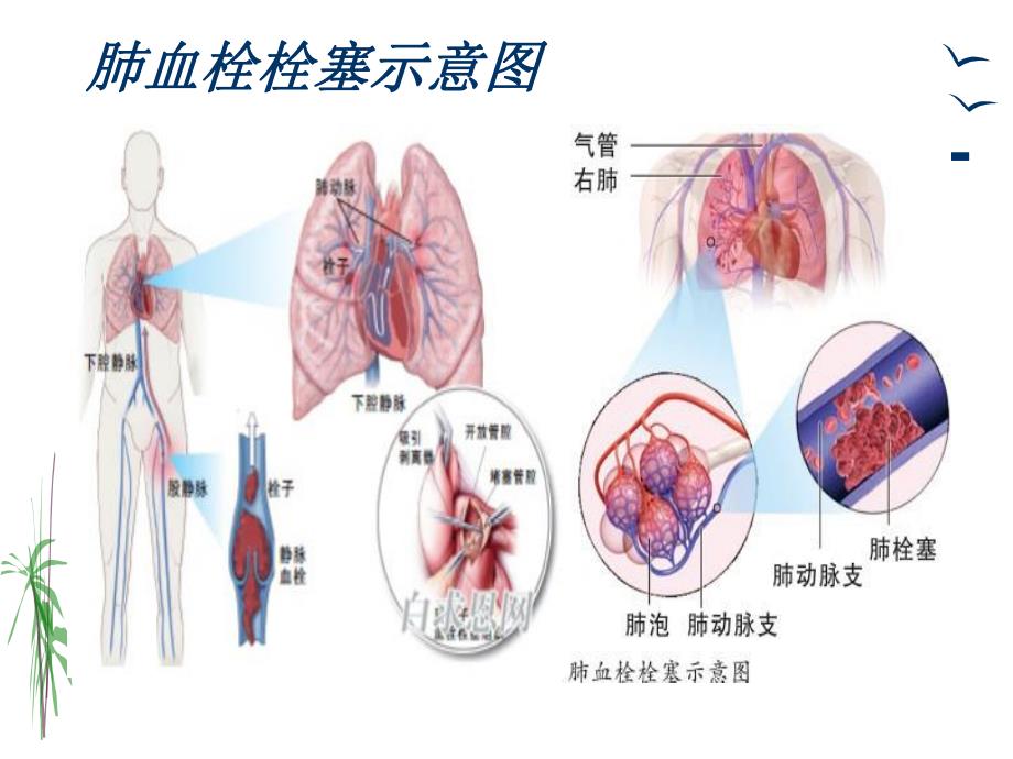 肺栓塞的治疗与护理.ppt_第3页