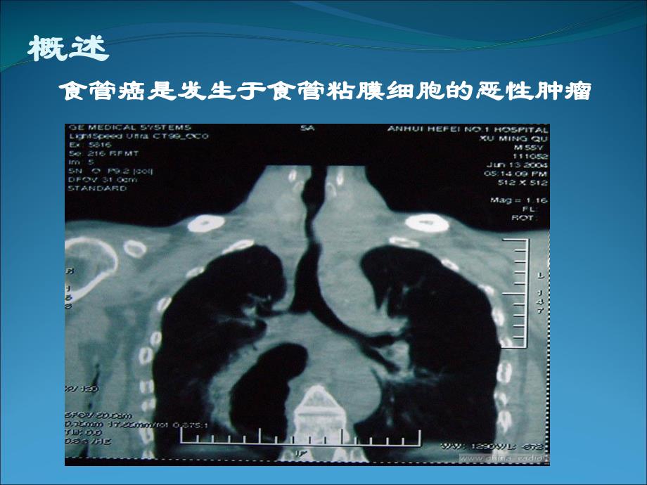 食管癌护理.ppt_第2页