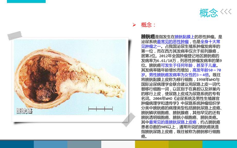 膀胱癌患者护理查房.ppt_第3页