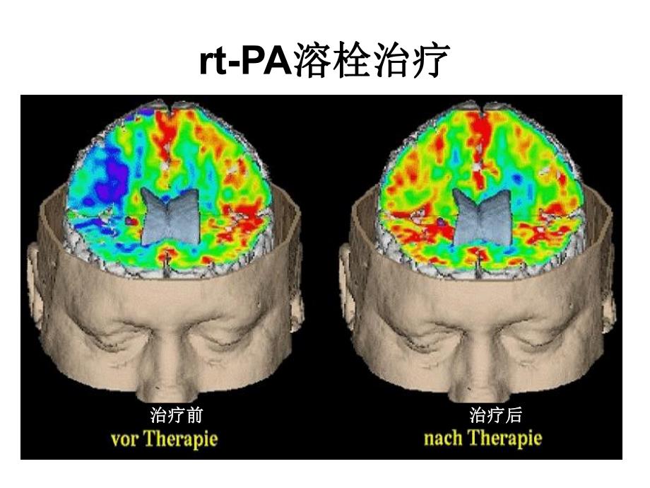 rtPA静脉溶栓的专家共识及临床治疗规范.ppt_第3页