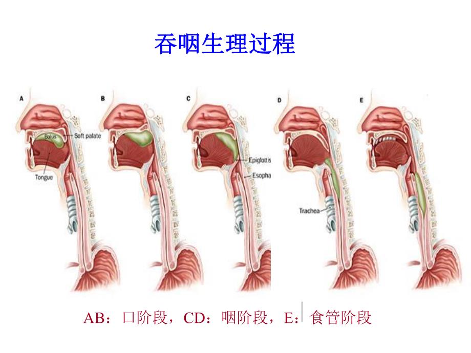 脑卒中后吞咽困难.ppt_第2页