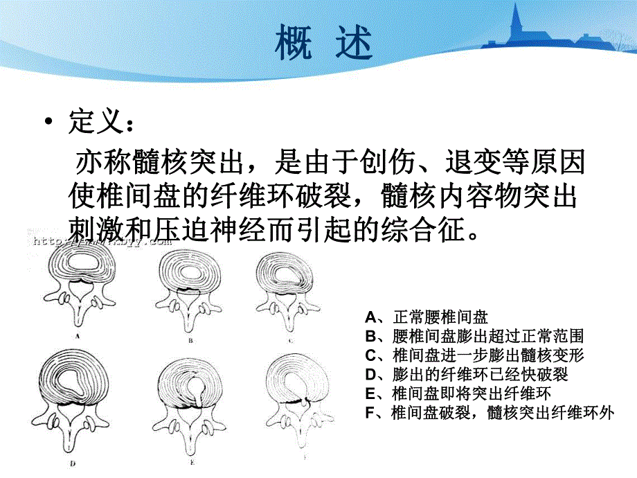 腰椎间盘突出症的康复护理.ppt_第3页