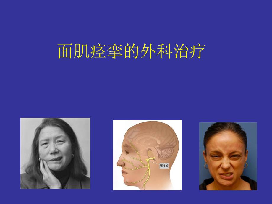 面肌痉挛.ppt_第1页