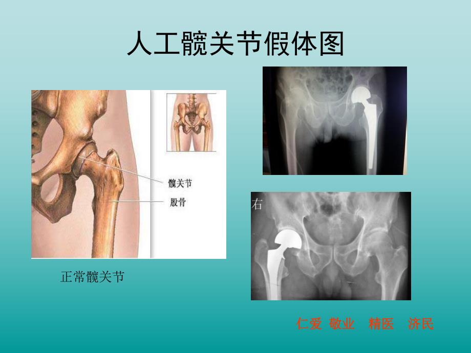 髋关节置换术健康康复训练教育.ppt_第2页