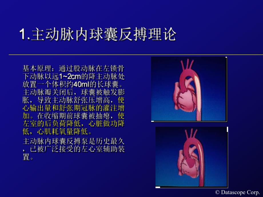 IABP主动脉内球囊反搏泵的临床使用.ppt_第2页