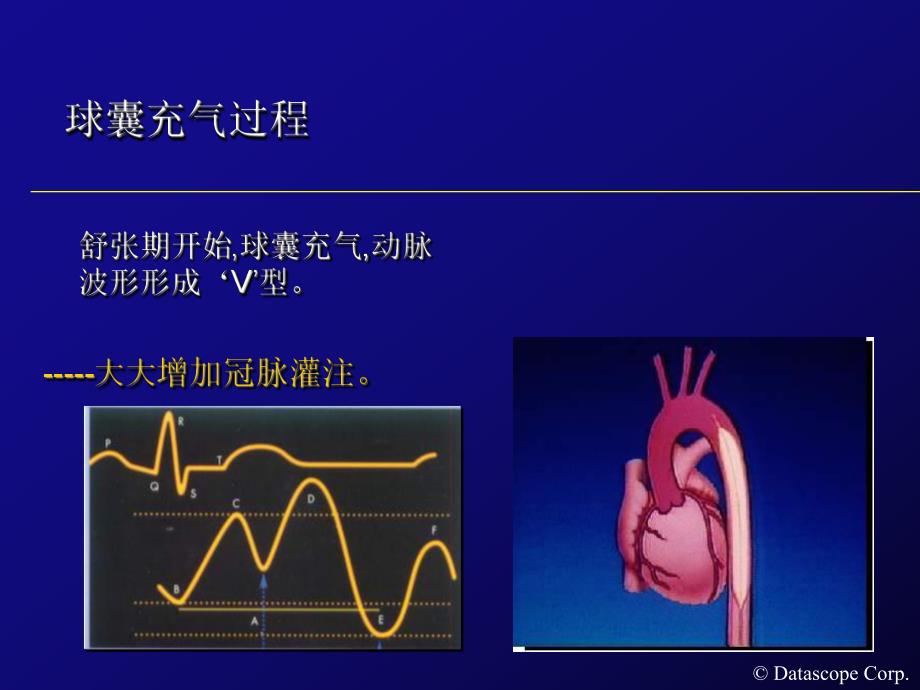 IABP主动脉内球囊反搏泵的临床使用.ppt_第3页