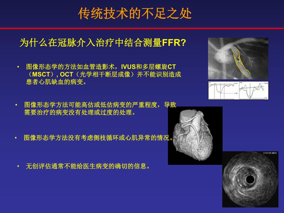 FFR的临床应用价值.ppt_第3页