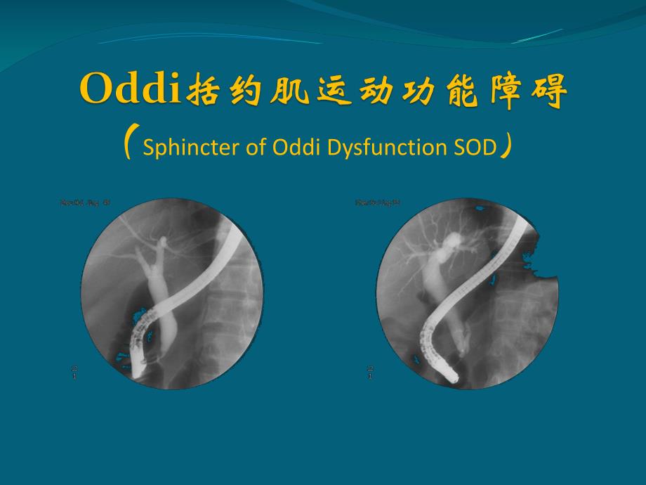 Oddi括约肌运动功能障碍.ppt_第1页