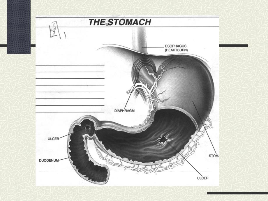 消化性溃疡2.ppt_第3页