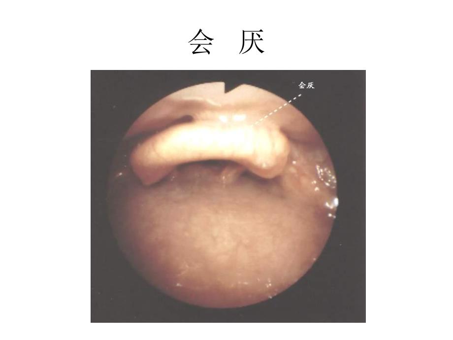 纤支镜的临床图谱.ppt_第1页