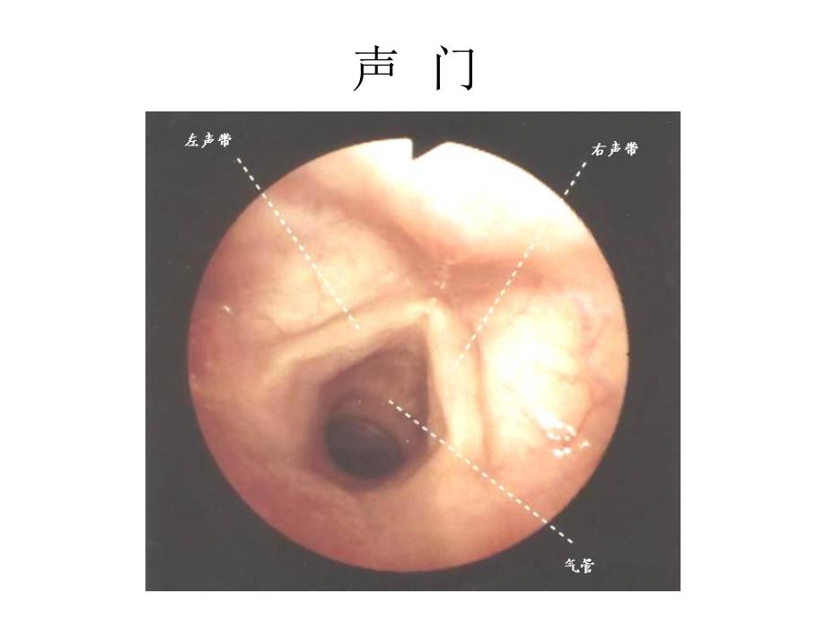 纤支镜的临床图谱.ppt_第3页