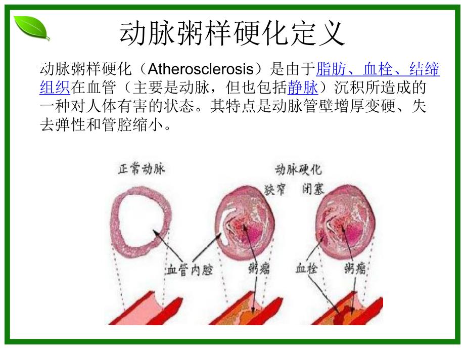 动脉粥样硬化1.ppt_第3页