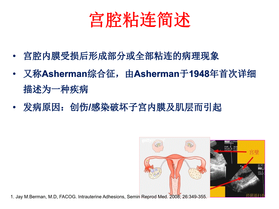 宫腔粘连诊疗策略.ppt_第3页