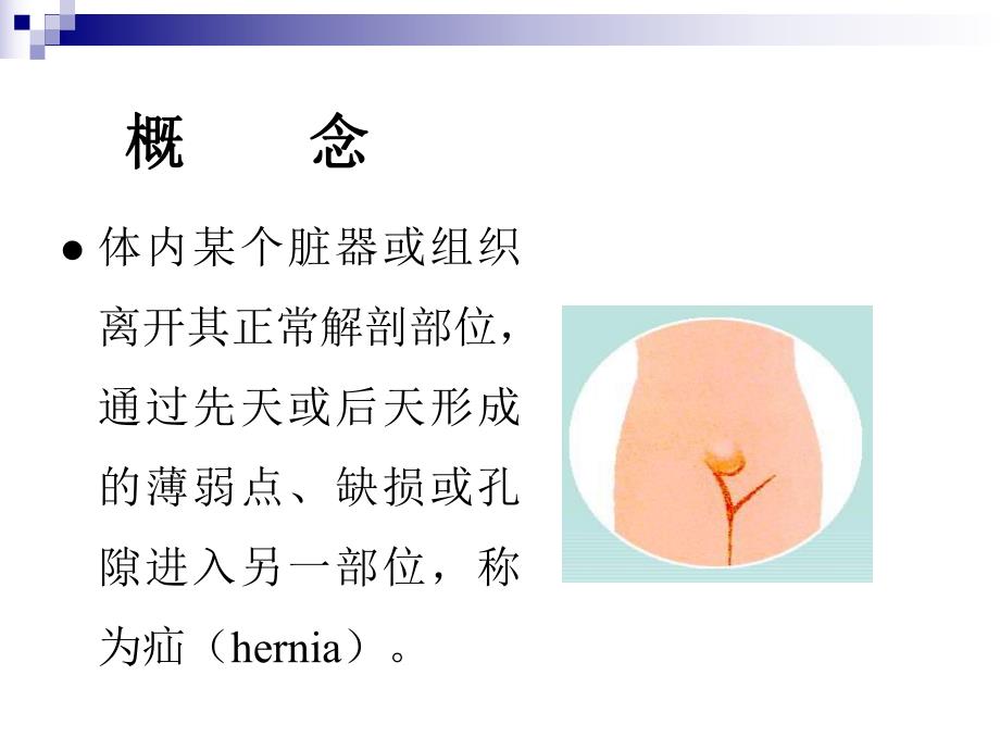 第40章腹外疝.ppt_第3页