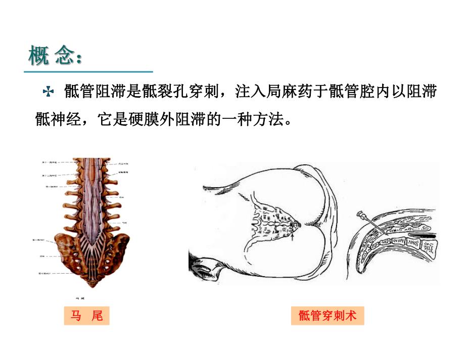 骶管麻醉PPT.ppt_第3页