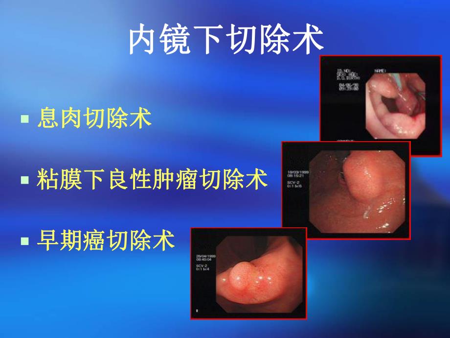 内镜下粘膜切除术.ppt_第3页