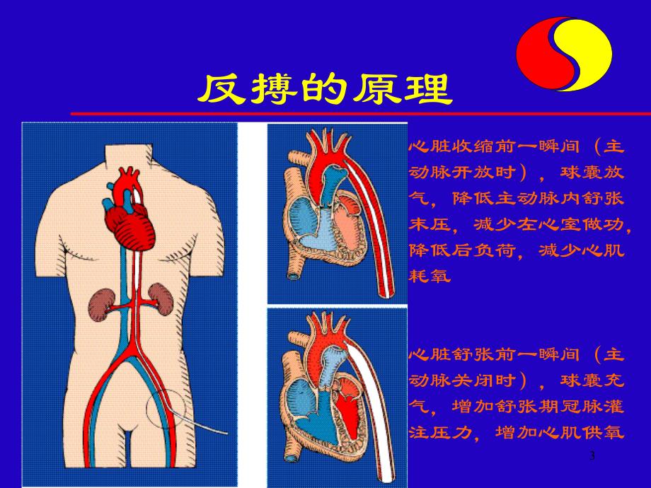 IABP讲义(程锐) (PPTminimizer)2.ppt_第3页