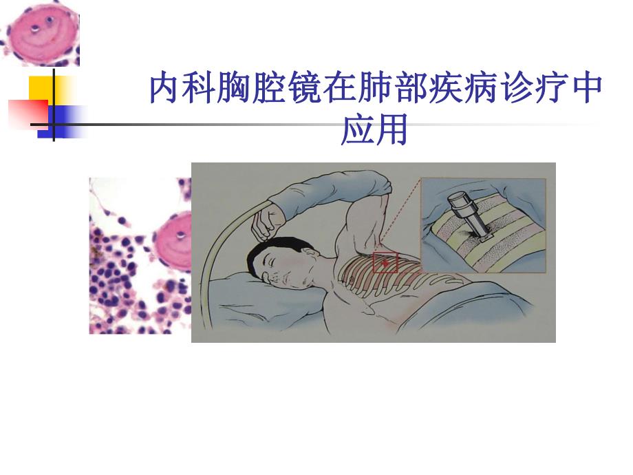 内科胸腔镜在肺部疾病诊疗中应用.ppt_第1页