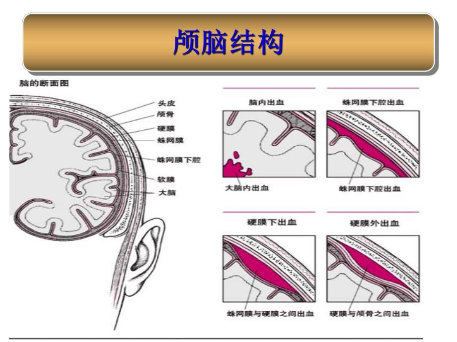 蛛网膜下腔出血护理.ppt_第3页