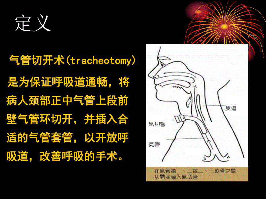 气管切开的护理.ppt_第3页