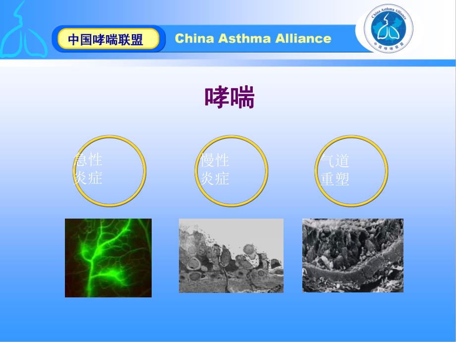 [精品]慢性哮喘的药物联合治疗.ppt_第3页