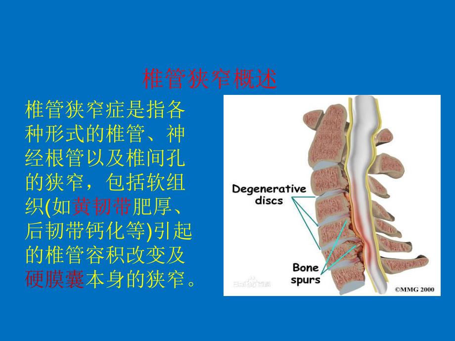 代谢性椎管狭窄.ppt_第2页