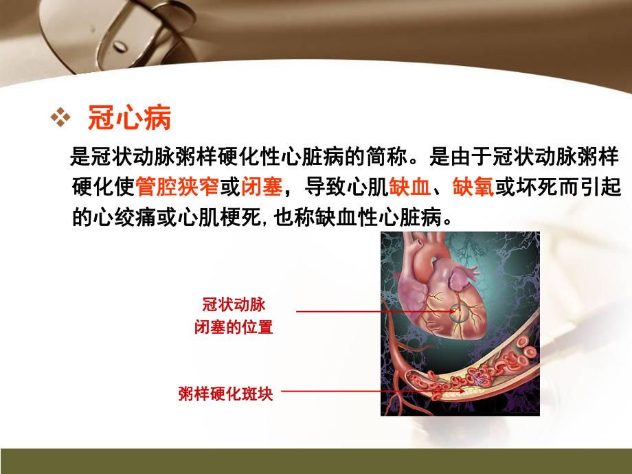 心肌梗死健康宣教.ppt_第2页