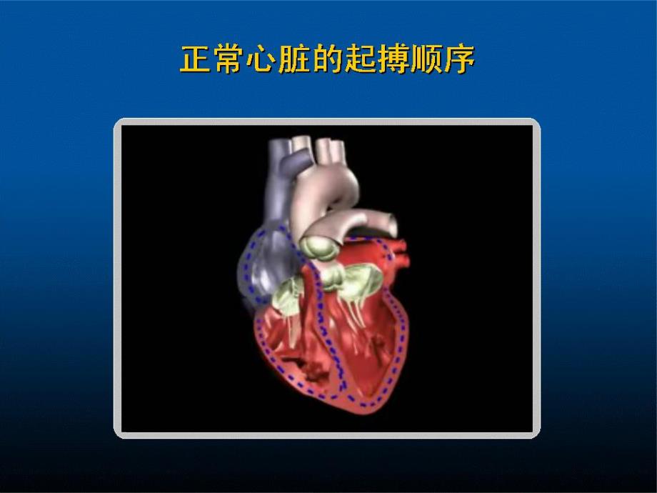 心脏再同步治疗.ppt_第2页