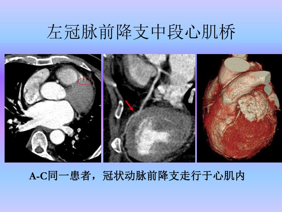 心血管疾病64层CTA诊断（三） .ppt_第2页