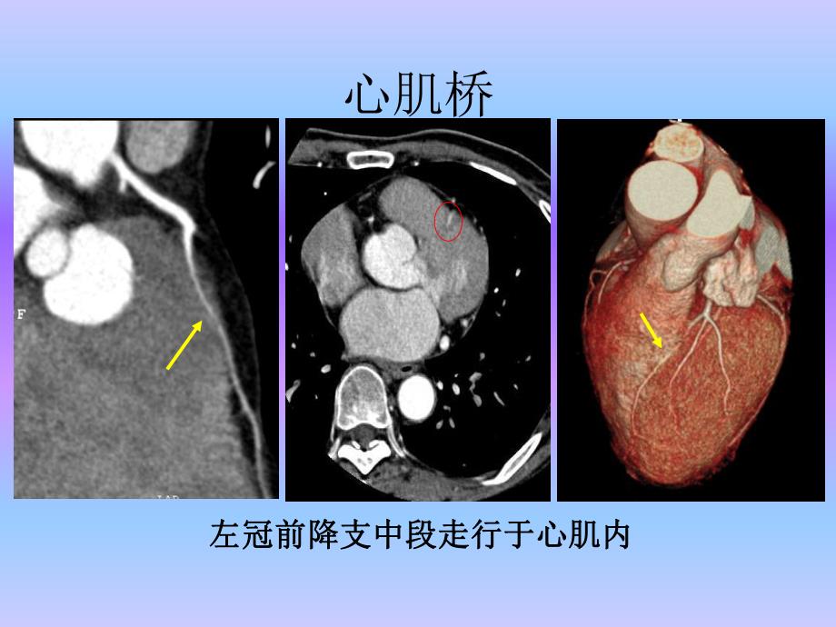 心血管疾病64层CTA诊断（三） .ppt_第3页