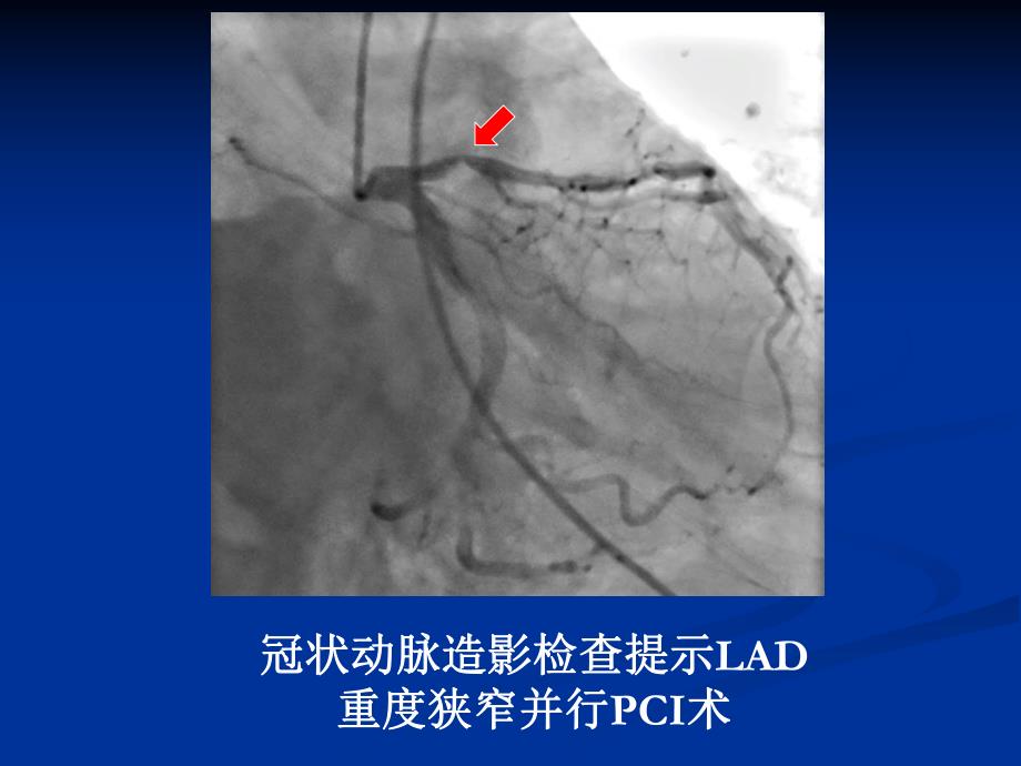 基因多态性与心血管疾病个体化用药.ppt_第3页