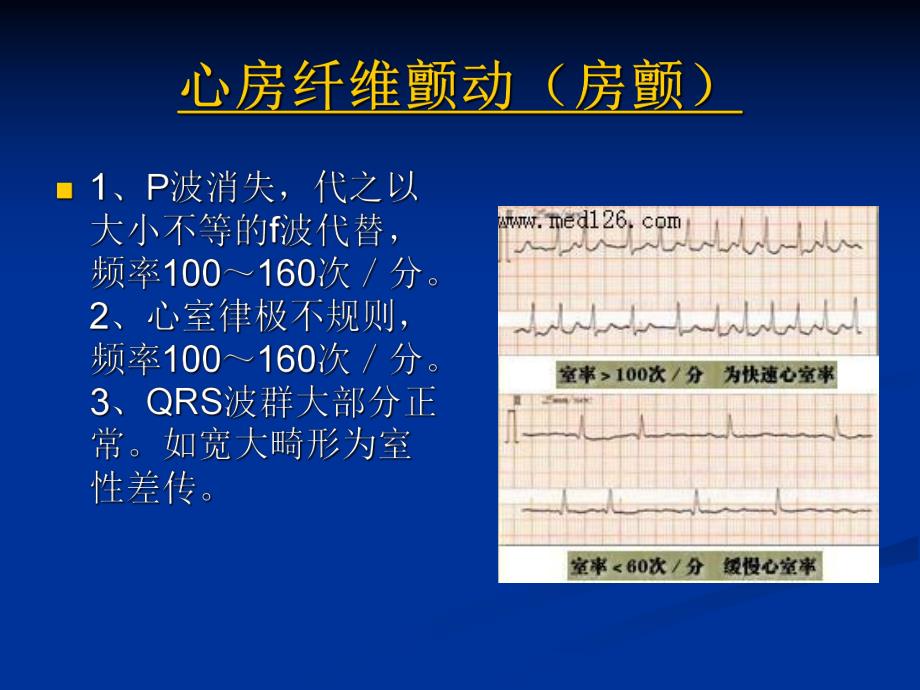 心房纤维颤动房颤.ppt_第1页