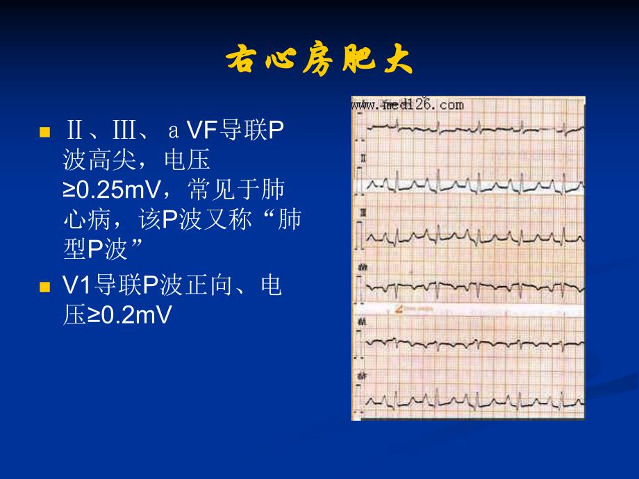 心房纤维颤动房颤.ppt_第2页