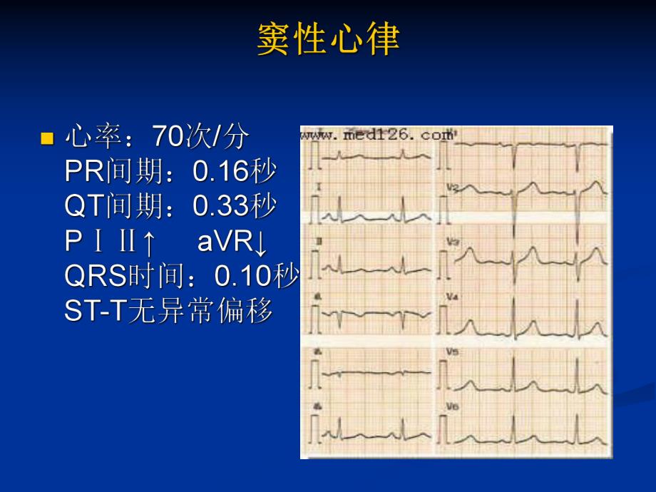 心房纤维颤动房颤.ppt_第3页