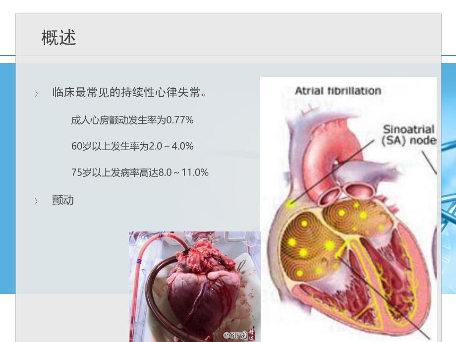 心房颤动ppt.ppt_第2页