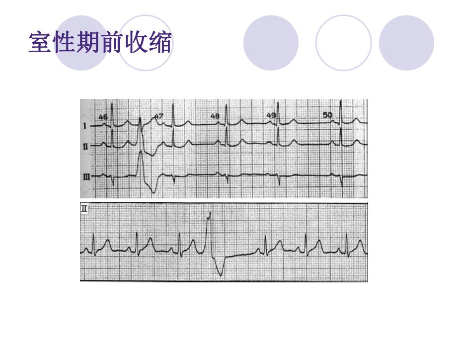 室性心律失常ppt.ppt_第3页